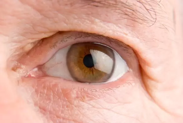 eye tumor